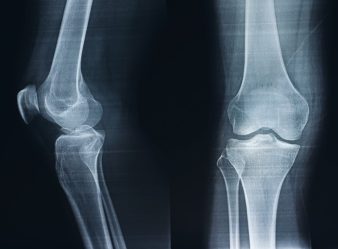 【医師が解説】膝の痛みや予防にサプリメントは本当に効くのか？