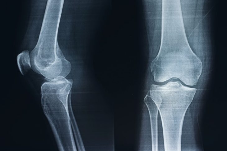 【医師が解説】膝の痛みや予防にサプリメントは本当に効くのか？