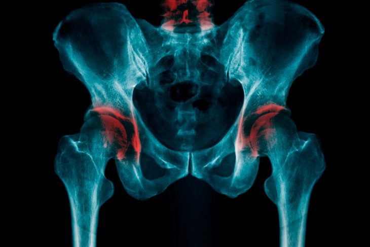 【医者解説】変形性股関節症とは何？股関節の痛みはこれが原因？！