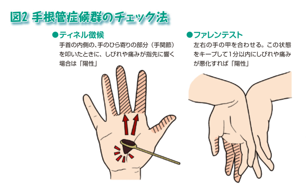 手根管症候群のチェック方法