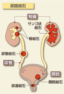 尿路結石