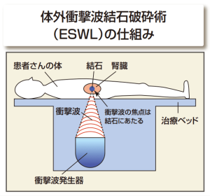 ESWLの仕組み