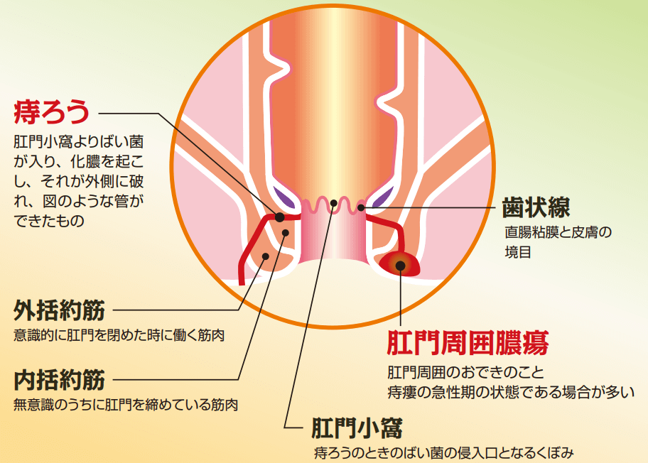 痔ろう