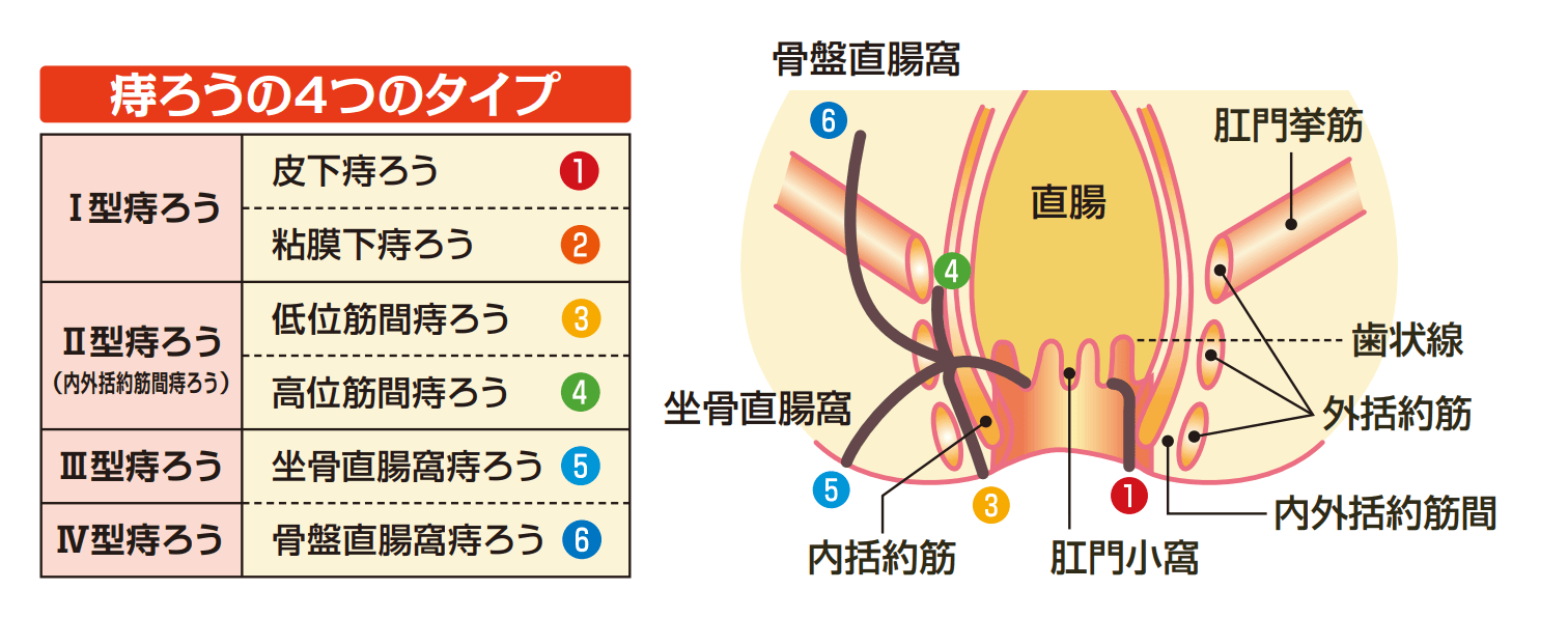 痔ろう　種類