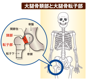 大腿骨頚部と大腿骨転子部