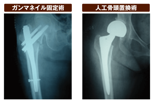 ガンマネイル固定術、人工骨頭置換術